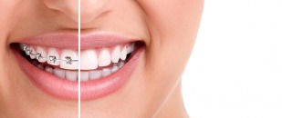 Le traitement orthodontique invisible